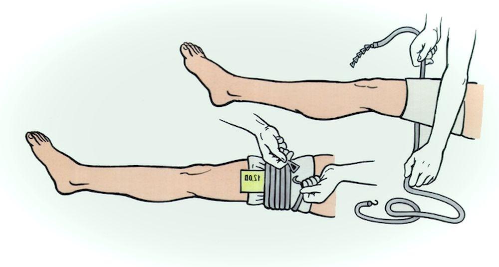 Как остановить кровотечение на ноге: лечение травмы