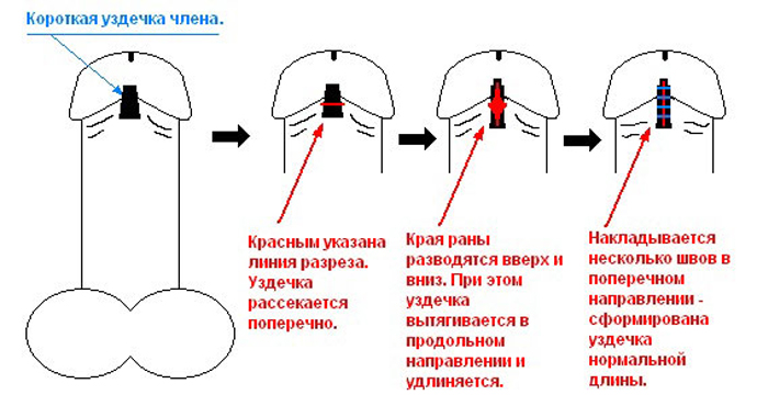 Схема френулотомии