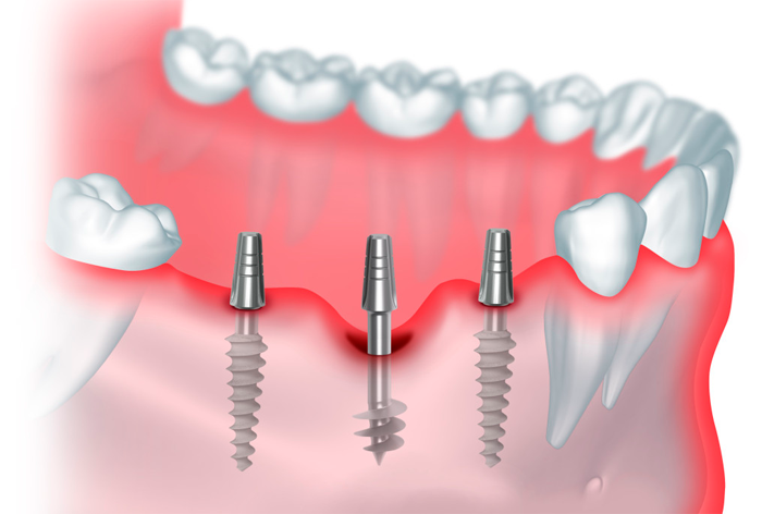 Последствия неудачной имплантации зубов